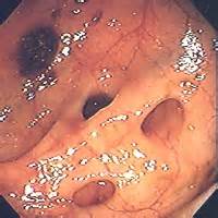 Malattia diverticolare del colon