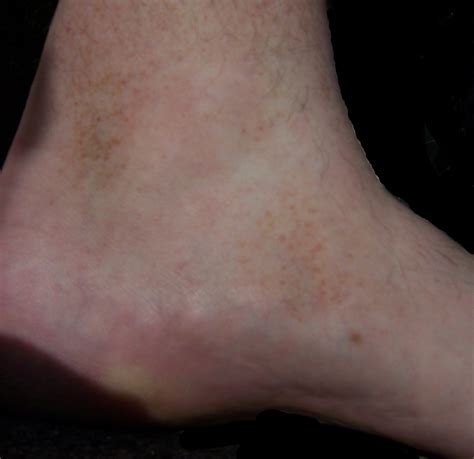 There may also be a rash, redness, brown discoloration or dry, scaly skin. Schamberg disease - Wikipedia