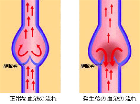 下肢静脈瘤の日帰り手術は福岡市のおだクリニック日帰り手術 ...