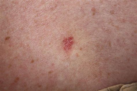 But it can occur in other areas, like the genitals, too, according to the skin cancer. Skin Cancer is Scary and Ugly. Here's What Mine Looks Like ...