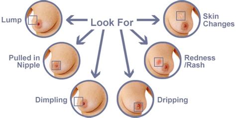 This early sign of inflammatory breast cancer can also be accompanied by tenderness of breast tissue. U.S. breast cancer cases to increase 50 percent by 2030 ...