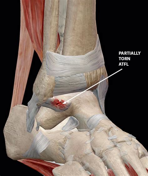 Like the mcl, the acl is one of four key ligaments that stabilize the knee. Common Ligament Injuries and Disorders