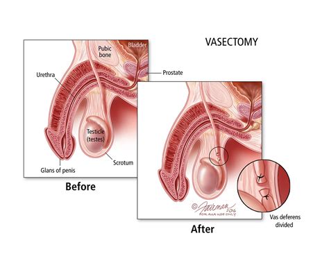 Or i'll come as soon as i've finished. Vasectomy: Causes, Diagnosis & Treatment | Atlantic ...