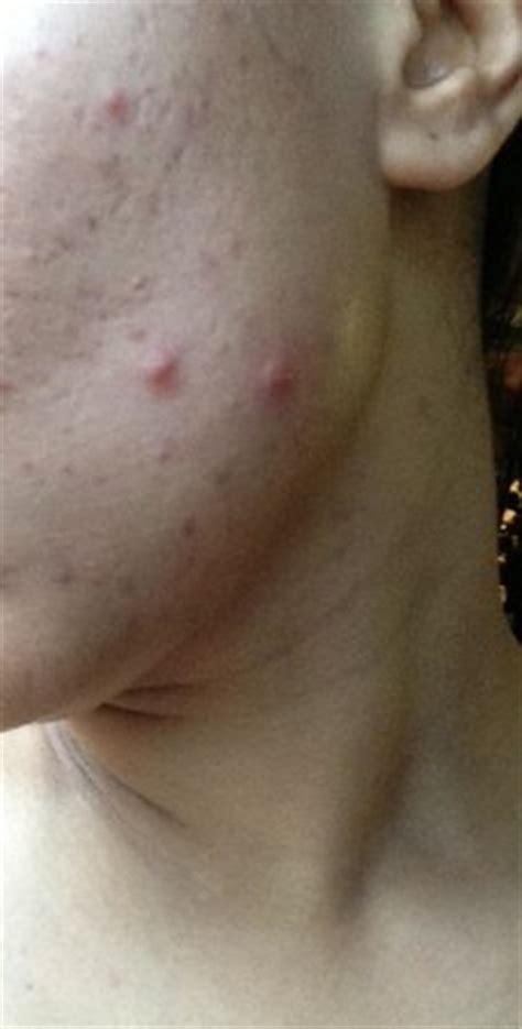 3737 west chapman avenue, orange, ca. Bed Bug Bites - Picture of Garden Grove, Orange County - TripAdvisor