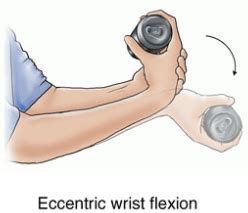 Tennis elbow — painful condition is caused by repetitive motions of the wrist and arm. Tennis Elbow Exercise | Singapore Sports and Orthopaedic ...