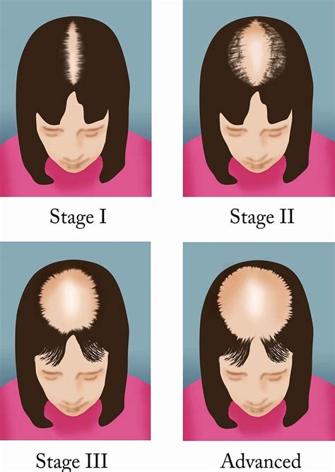 Male or female pattern baldness causes and baldness treament