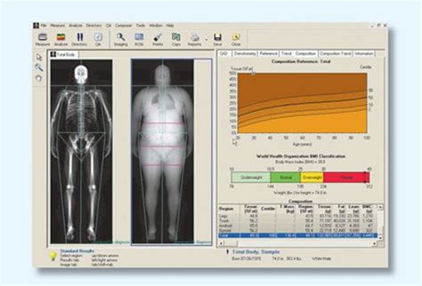 A bone density scan tells your doctor how strong your bones are by using a numbered score. What Is Osteoporosis? Treatment, Symptoms, Medication