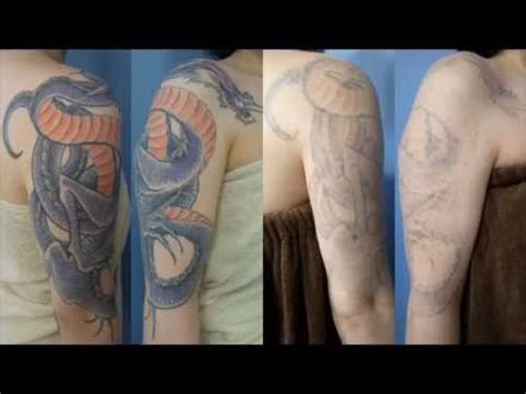 Regular price $319.95 sale price $199.95. 刺青除去(カラー)途中経過 Laser Tattoo Removal (Color Tattoo) Interim ...
