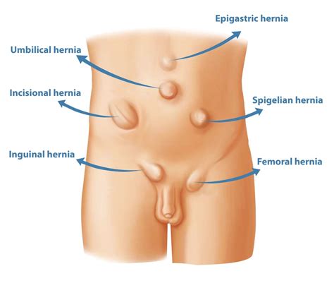 The discomfort worsens with any activity that puts a strain on the abdomen, such as heavy lifting, running. Different types of hernia. What type of Hernia do I have?