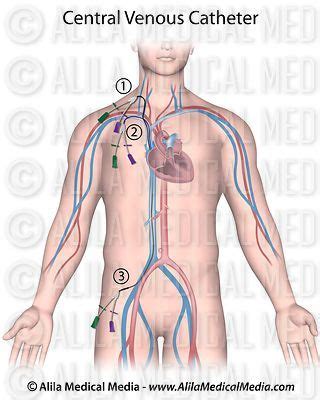 Monitoring central venous pressure (only jugular). Alila Medical Media | Heart and Circulatory System Images