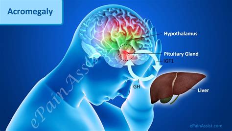 In cats, these tumors grow slowly and may be present for a treatment of acromegaly may include medical therapy (pasireotide), radiation therapy or hypophysectomy. What Are The Causes Of Acromegaly | Endocrine disorders ...