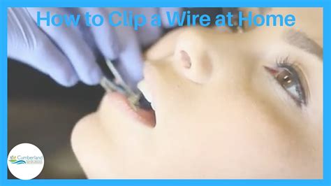 Check spelling or type a new query. Cutting Braces Wire With Nail Clippers - NailsTip