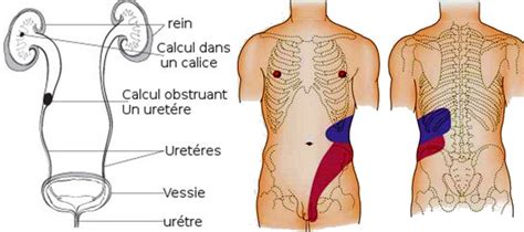 Pas d'imagerie aux urgences colique néphrétique • la plupart des cn évoluent favorablement sous traitement, permettant un retour à domicile, après. Colique néphrétique, inutilité des traitements pour ...