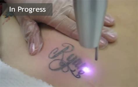 The versatile lumina ® offers laser tattoo removal as well as over 24 other aesthetic treatments. Laser Tattoo Removal Examples by Light Fantastic IPL