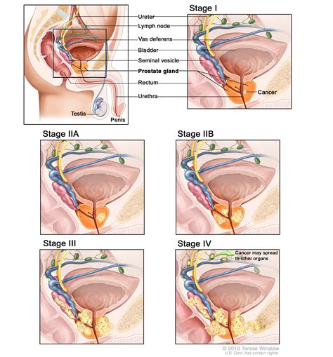 Early prostate cancer symptoms include urinary & sexual problems. stage C prostate cancer (Patient) - Siteman Cancer Center