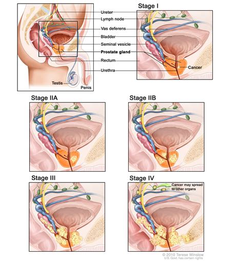 Most often, prostate cancer spreads to the bones or lymph nodes. stage C prostate cancer (Patient) - Siteman Cancer Center