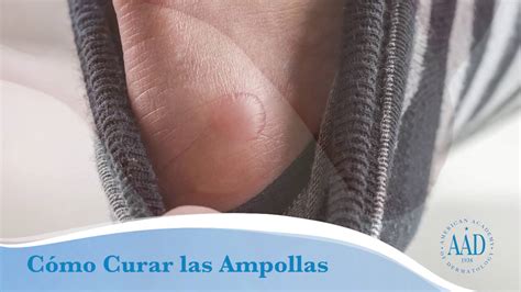 219 comentarios en como curar candidiasis con ajo. Cómo Prevenir y Curar Ampollas - YouTube