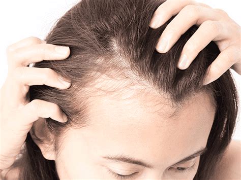 Les belles boucles par contre, ne perdez pas de vue que les boucles longues demandent. Quelle Coupe Quand On Perd Ses Cheveux Femme - Calvitie ...