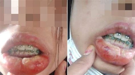 Apakah pasang gigi palsu bisa pakai bpjs? Bibir Wanita Ini Membengkak Gara-gara Menggunakan Kawat ...