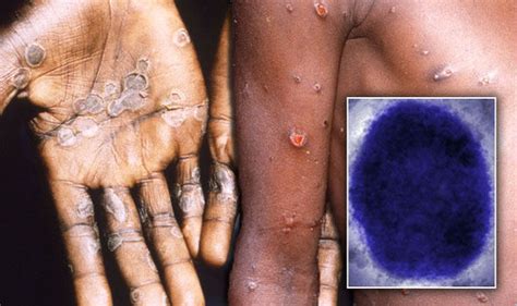 Getty) those with the condition can experience some, or a variety, of these symptoms. Monkeypox virus: Infection spread in UK by clothes and ...