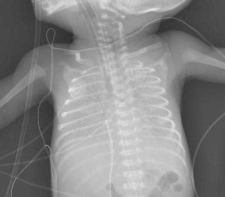 Hyaline membrane disease x ray. Hyaline membrane disease | Image | Radiopaedia.org