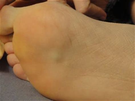 Click on the like button for this video. Mystery of the foot cyst - update