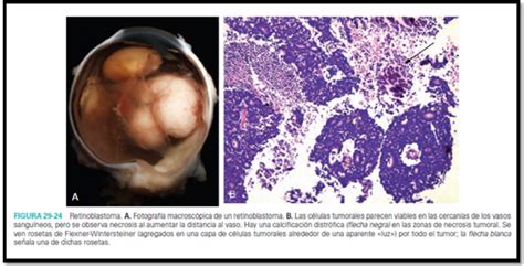 Retinoblastoma comprises 3% of pediatric malignancies, with 2 to 5 cases per million children per year and 300 new. Patogenia de Retinoblastoma - Bases Moleculares del Cáncer