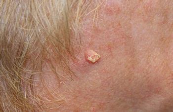 Squamous cell carcinoma is becoming more common, most people who get it are cured after treatment. Types of Skin Cancer | Cancer Care Centers of Brevard