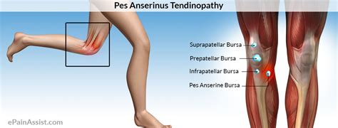 Pes anserinus is the anatomic name given to the conjoined tendons at the medial aspect of the knee that inserts onto the anteromedial aspect of the tibia. Gåsfot - Pes Anseritis Bursitis - Joggingskor.nu