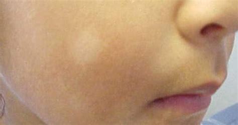 Tillståndet kännetecknas av hypopigmenterade runda eller ovala fläckar företrädesvis i ansiktet och förekommer främst hos barn och ungdomar. Pityriasis Alba - White spots on face of child - Key To ...