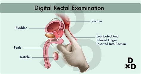 A complete physical examination includes a digital rectal examination. The Ultimate Guide To Dealing With Prostate Cancer By A ...