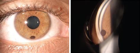 In a normal individual there's enough to last you a lifetime! A Moving Black Spot in My Vision | Ophthalmology | JAMA ...