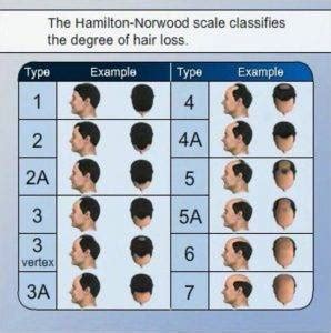 The norwood scale is the standard measure of hair loss progression in men. Hamilton Norwood Scale - Measure Hair Loss WIth Hamilton ...