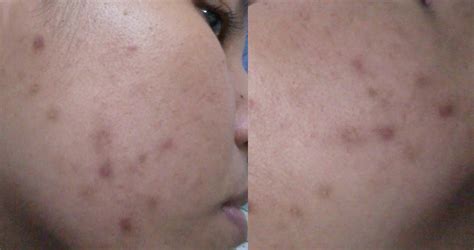 3 ways to reduce scars on face! Unleash your inner glow~: Cara Hilangkan Parut Jerawat