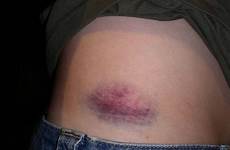 bruises remedies choose board therapy care