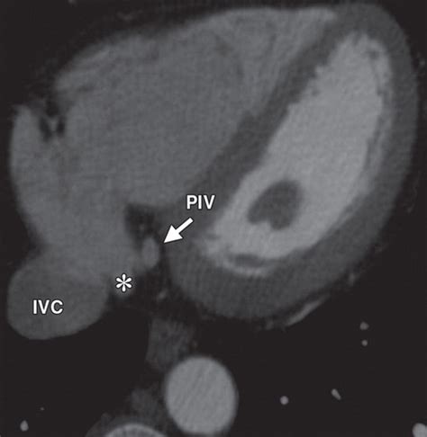 Multidetector ct has become an important tool for noninvasive evaluation of cardiovascular the coronary ostia are usually located in the upper third of the respective sinus of valsalva. Imaging of the Coronary Sinus: Normal Anatomy and ...