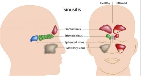 How to sleep with a toothache. Sinusitis and Toothache 101: How are they related to each ...