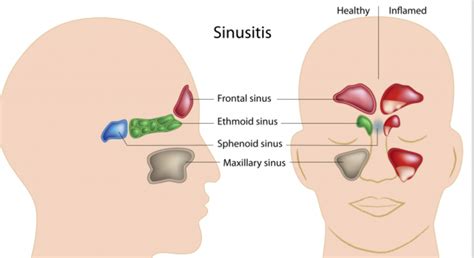 Try these five tips for relieving sinus infection tooth pain: Sinusitis and Toothache 101: How are they related to each ...