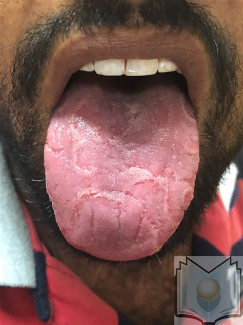 Geographic Tongue Article - StatPearls