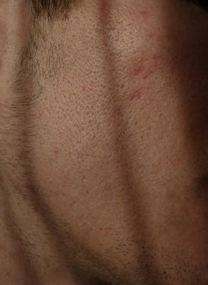 Where ever there is skin, there are pores. Scarred And Enlarged Pores (With Photos).... Any ...