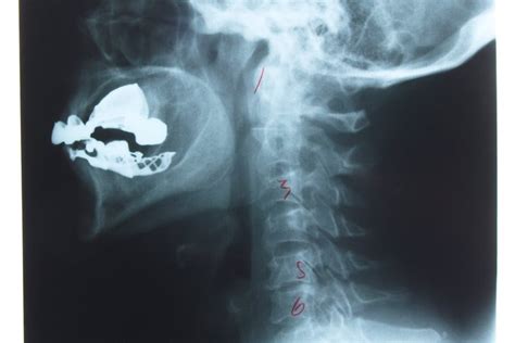 Fascias del cuello son membranas de tejido conectivo que rodean las estructuras del cuello (como el papel celofán lamina pretraqueal de la fascia cervical: Lesiones en los nervios del cuello | Muy Fitness