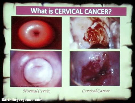 Cervical cancer is cancer that starts in the cervix, the narrow opening into the uterus from the vagina. Eat. Drink. Dance. (Repeat!): No Drama in Cervical Cancer