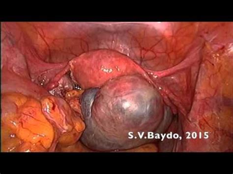 For starters, the symptoms are way too easy to ignore. Laparoscopic management of early ovarian cancer - YouTube