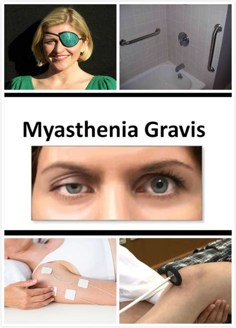 Open access maced j med sci. Myasthenia Gravis Diagnosis | New Health Advisor