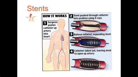 The right side of the heart receives deoxygenated blood from the body and pumps it to the lungs where oxygen diffuses in from the alveoli and carbon dioxide diffuses out GCSE - transport - human - YouTube