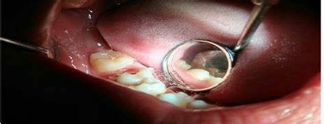 Pembusukan gigi yang disebabkan oleh gigi berlubang. Dalam beberapa kasus, beberapa sakit gigi disebabkan oleh ...