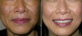 Everyone is different, but in general most people begin to see a measurable difference after 1 to 3 visits. IPL Lume One™ PhotoFacial/Decollette January '18 Promo ...