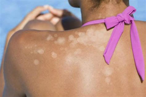 Treatments for white spots on skin. Remove Pesky White Sunspots With These 8 Simple Home Remedies