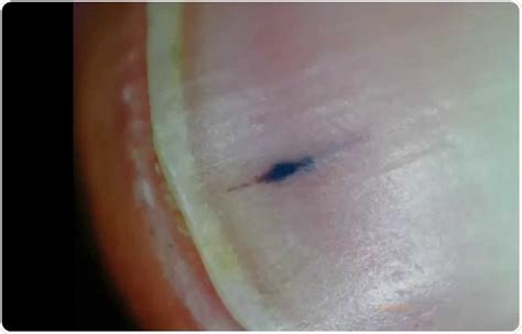 This can be done multiple times daily, but try melanoma usually appears as a dark brown to black unusually shaped spot, and when it occurs near or under the toenails it can look like a long dark streak through the nail. Splinter Hemorrhages