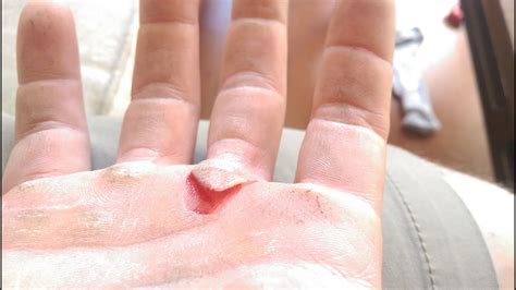 How can i get rid of calluses on my hands? Damaged skin from rings ? : bodyweightfitness